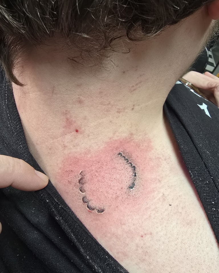 Realistic Bite Mark Tattoo